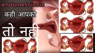 endometriosis