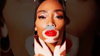 Unique beauty: The rise of Winnie Harlow #winnieharlow #supermodel #uniquebeauty #vitiligomodel