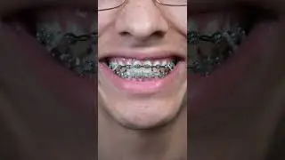 4 Month Braces Journey