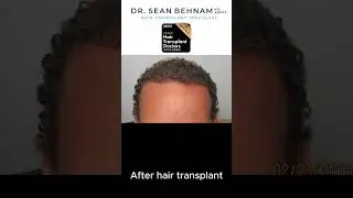 Curly hair - Hair transplant