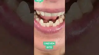 Braces Alternatives for Smile Correction | Smile Craft Dental Studio