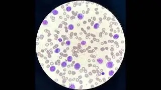 Acute leukemia  AML,few blasts, Megakaryoblasts .