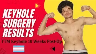 10 Weeks After My FTM Top Surgery | My Honest Recovery Journey 🏳️&zwj;⚧️