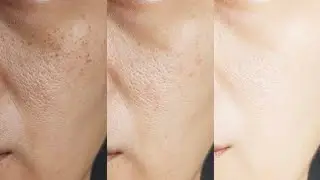 Best Summer Solution for Pigmentation & Tan Removal | 100% Natural Home Remedy