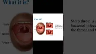 Siddha Medicine for Strep Throat | Natural Healing Solutions