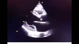 Echo case study #echocardiography #echo #heartmonitoring #healthcare @SafaMedicalLecture