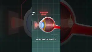 New Eye Implant Might Save Your Eyesight