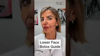Lower Face Botox  #lowerfacebotox #botoxdosing #botoxtraining #drbitafarrell