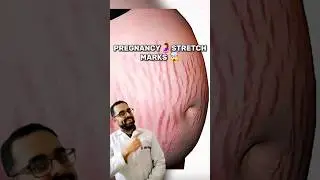 Pregnancy Stretch Marks 🤯 #pregnancystretchmarks #stretchmarksremoval