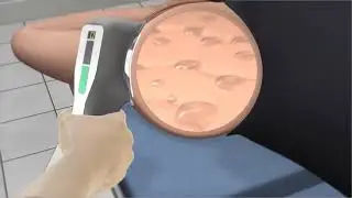 miraDry Clinical How To Video