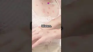 #mpoxoutbreak #monkeypoxvaccine