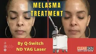 Melasma Treatment by Q Switch Nd || Laser Melasma treatment | Clear Skin Hair & Laser Centre Kurnool