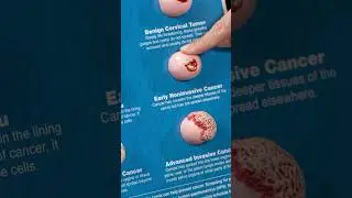 Stages of cervical cancer - From benign to advanced