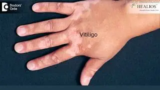 Effectiveness of suction grafting melanocyte transplantation for Vitiligo - Dr. Pavan Murdeshwar