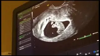 Surrogacy Journey | Part 6 | Heartbeat Confirmation