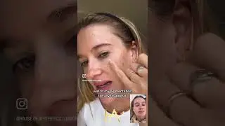 How to Get Rid of Facial Pigmentation? | Real IPL Treatment Results