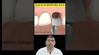 टूटे हुए दांत को कैसे ठीक किया जाता है ? #shorts #youtubeshorts #brokenteeth​