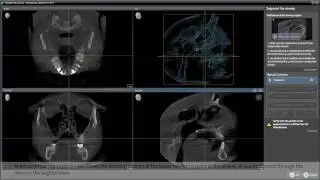 SICAT Air - Segmentation
