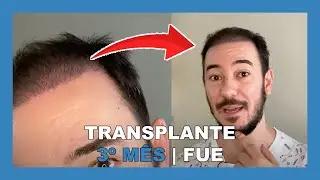 RESULTADO 3 MESES - TRANSPLANTE CAPILAR FUE