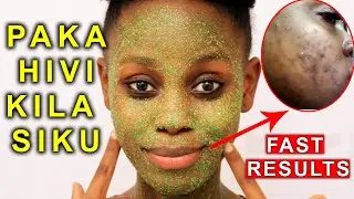 Kuondoa CHUNUSI na MADOA SUGU USONI kwa haraka | How to get rid of ACNE in a week
