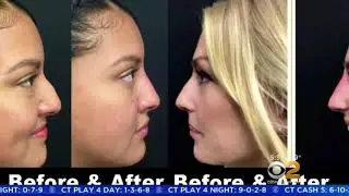 Skip The OR With These Wide-Awake Cosmetic Surgery Procedures