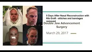 Nasal Reconstruction Rhinoplasty with Rib Graft - stitches removed - 5 days post