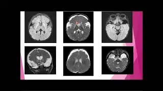 Les anomalies de signal des noyaux gris centraux : l'Acidurie glutarique type 1