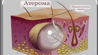 Ateroma xaqida qisqacha ma&rsquo;lumot ( teri osti qavatida uchraydigan o&rsquo;simta )