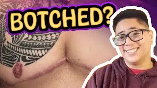 Getting a Revision 10 Months After Top Surgery! Trans FTM