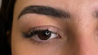 Eyelid Lifting by Plasma Fibroblast skin tightening