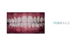 inBrace Morph lingual braces hybrid