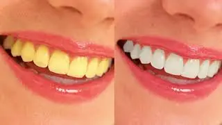 Realistic teeth whiten photoshop tutorial