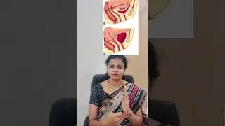 IUI procedure- explained step by step