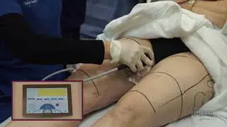ThermiSmooth