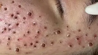 Relax every day with Acne treatment with TM Queen yt #Nasa20032