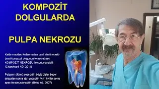 Beyaz kompozit diş dolgusundan sonra meydana gelen diş ağrısı nekrozu ve diş apsesi Kompozit nekrozu