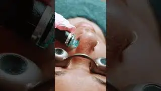 #blackheads #largepores #cloggedpores #hydrafacial #extractions #skincarelove