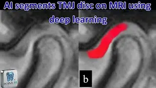 AI segments TMJ disc on MRI using deep learning
