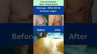 Breast Lift Treatment  best breast for Lasting Elegance #hospital #breastsurgery #shorts