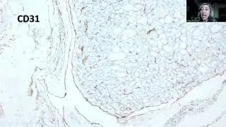Tip-130;Follicular Thyroid Carcinoma