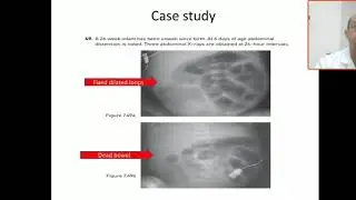 Case 128 fixed dilated bowel indicate dead bowel, NEC ,necrotising enterocolitis, surgical  emergenc