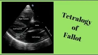 Pediatric Echo for the Adult Technologist-Tetralogy of Fallot