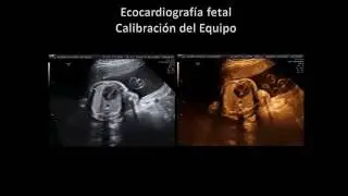 Ecocardiografía fetal Calibración del Equipo