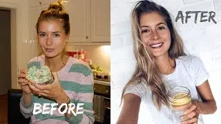 HOW I FINALLY HEALED MY ACNE NATURALLY (birth control, digestion, food)  // EASY TIPS