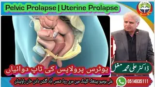 Uterine Prolapse / Pelvic Prolapses and it's Treatment !! Dr Ali Muhammad