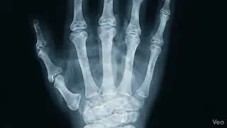 X ray of a human hand with glowing blue light Keywords x ray, hand, human, anatomy, bone