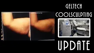 Geltech/Coolsculpting: 4 Month Update