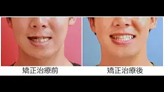 26歳 男性 「手術なしで 受け口を 治してほしい」（骨格的な要因を伴う 反対咬合）治療期間1年10か月