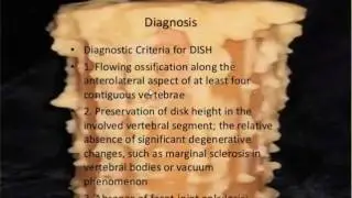 Cervical Stenosis and DISH diffuse idiopathic skeletal hyperstosis