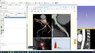 3D Slicer Coronary Segmentation on CT (contrast & non-contrast) for PCAT calculation